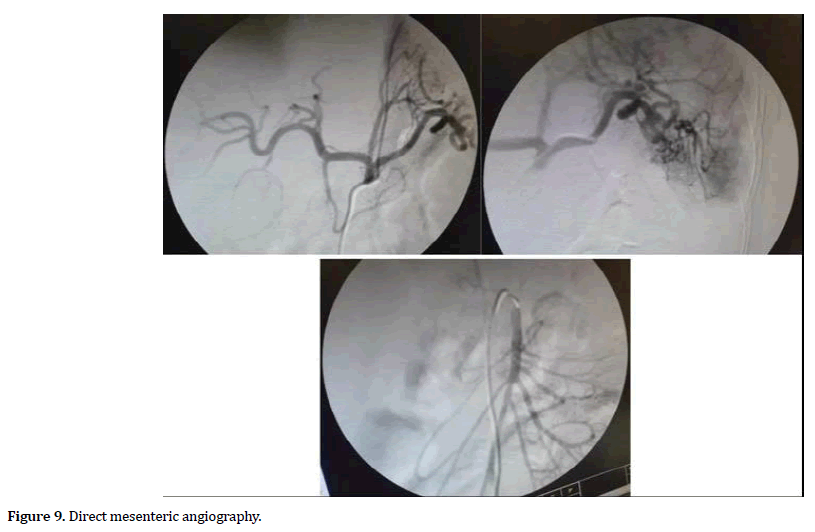 pancreas-direct-mesenteric