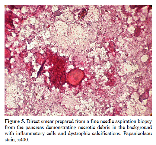 pancreas-direct-smear-needle-aspiration