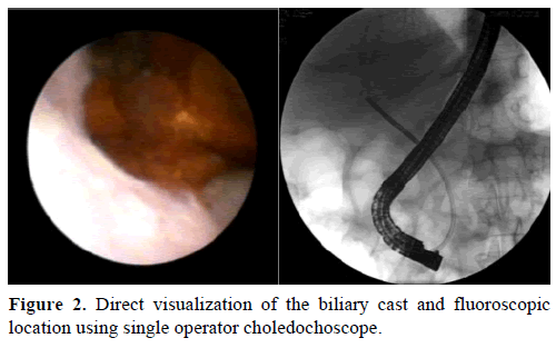 pancreas-direct-visualization-biliary