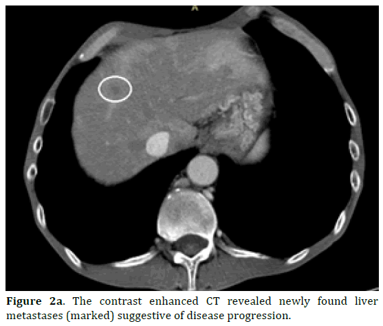 pancreas-disease-progression