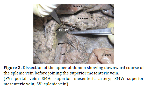 pancreas-dissection-mesenteric-vein