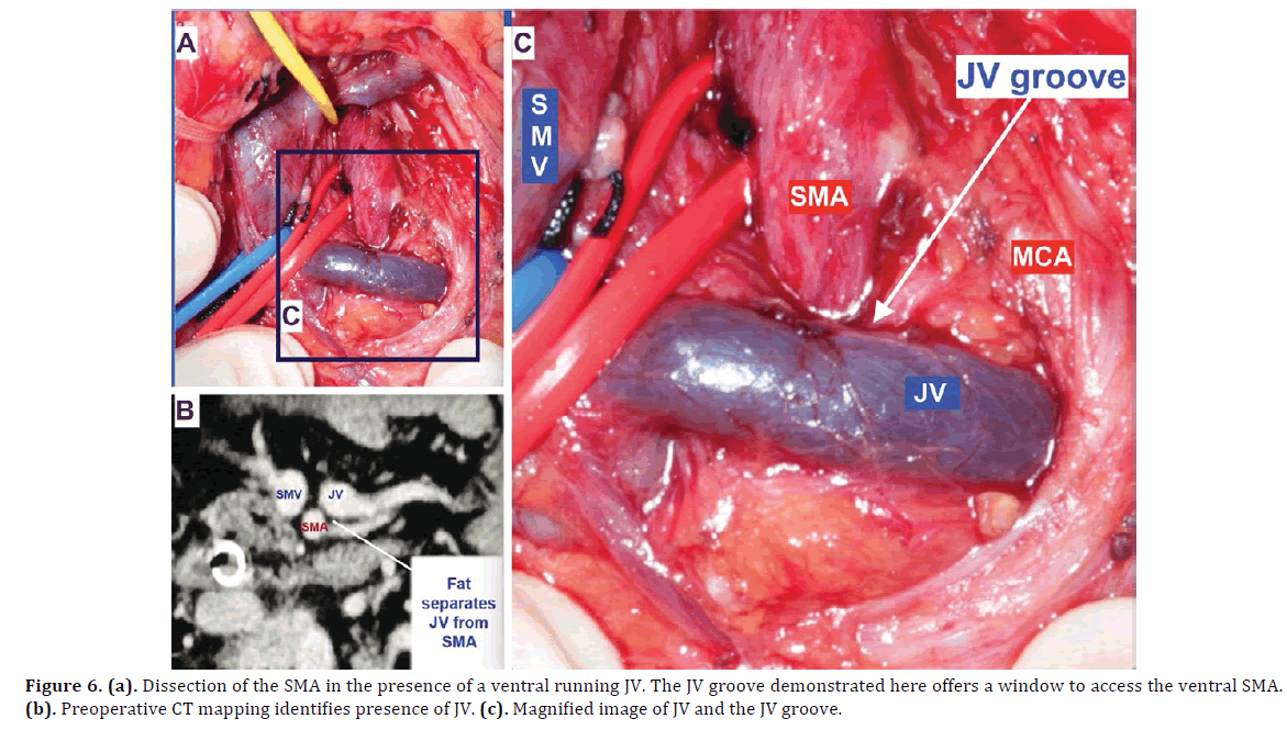 pancreas-dissection-presence