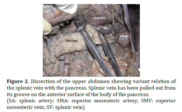 pancreas-dissection-splenic-vein