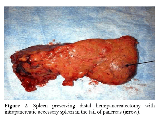pancreas-distal-hemipancreatectomy