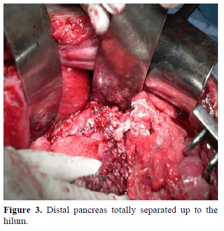 pancreas-distal-pancreas-separated