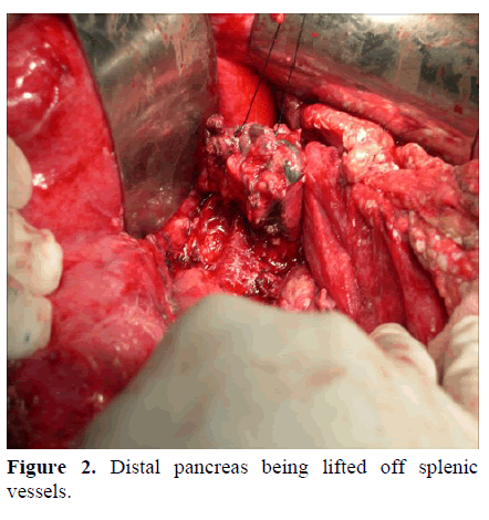 pancreas-distal-pancreas-vessels