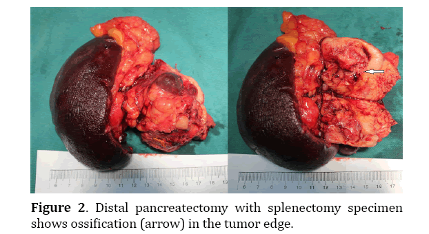 pancreas-distal-pancreatectomy