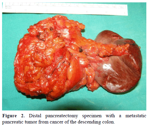 pancreas-distal-pancreatectomy-specimen