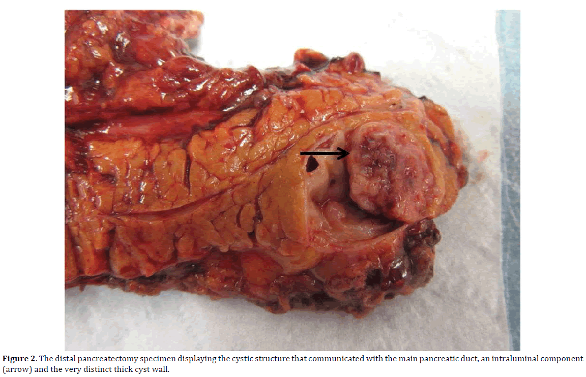 pancreas-distal-pancreatectomy-specimen
