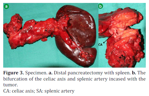 pancreas-distal-pancreatectomy-spleen