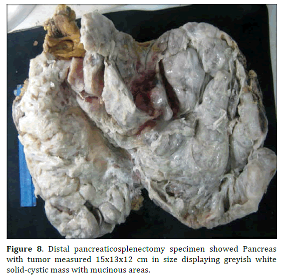 pancreas-distal-pancreaticosplenectomy-specimen