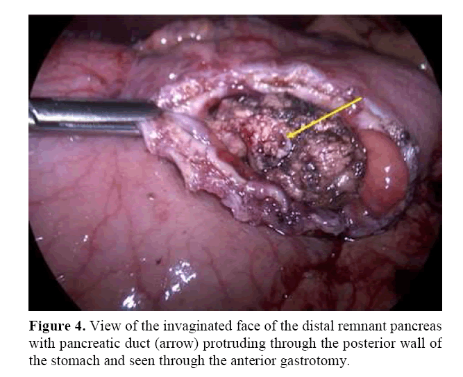 pancreas-distal-remnant-pancreas