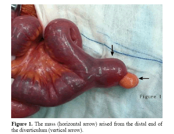 pancreas-diverticulum-vertical-arrow