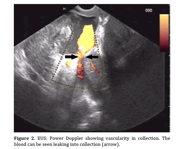 pancreas-doppler-showing-vascularity