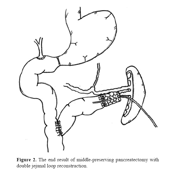pancreas-double-jejunal-loop