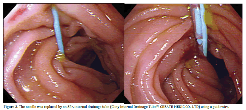 pancreas-drainage