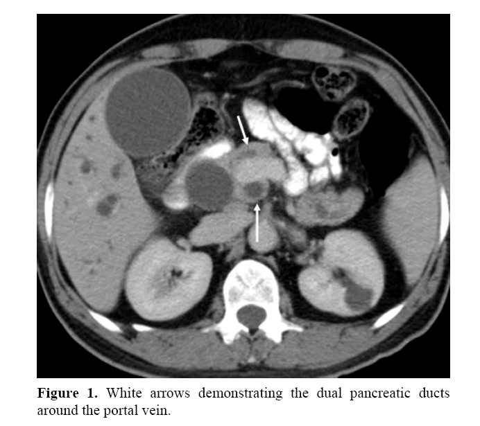 pancreas-dual-pancreatic-ducts