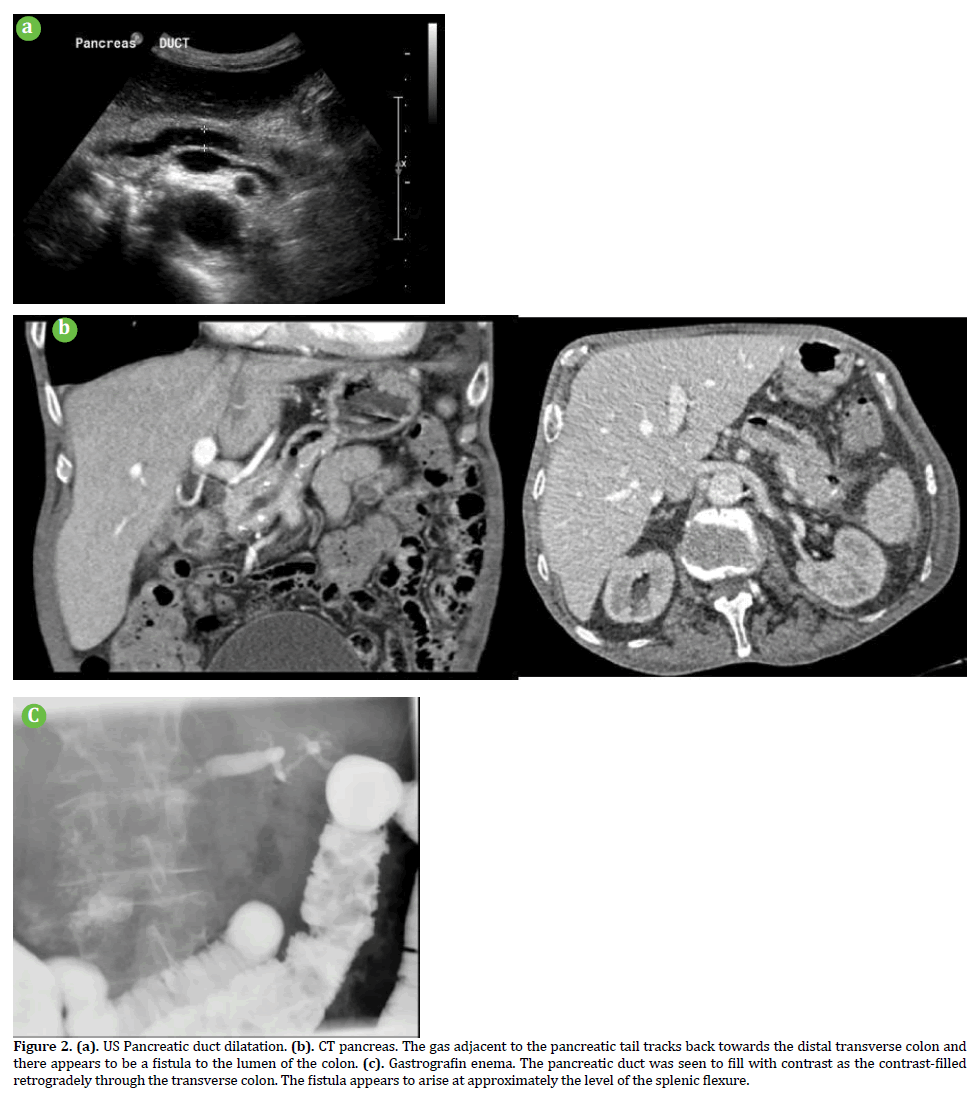 pancreas-duct-dilatation