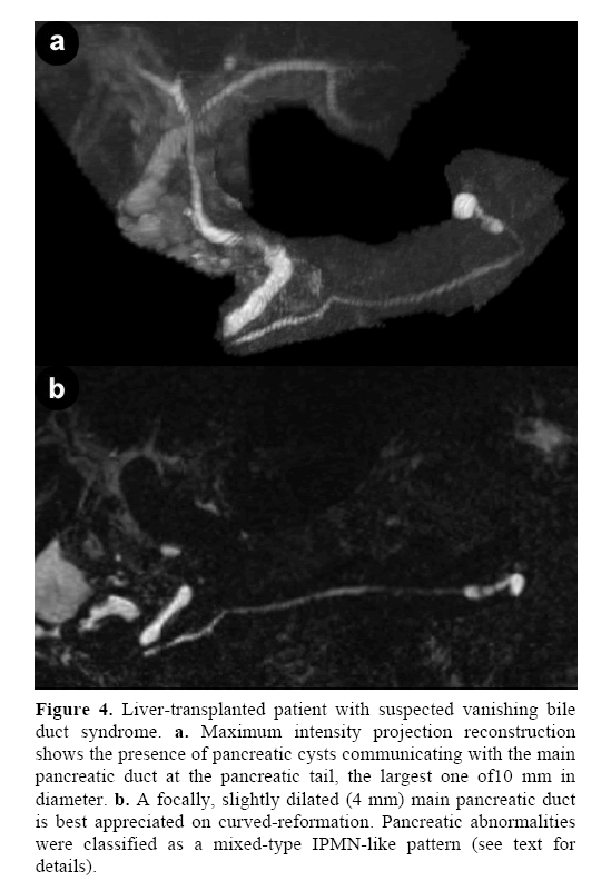 pancreas-duct-syndrome