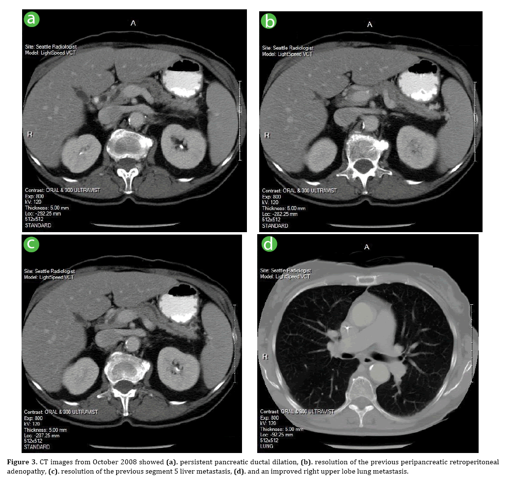 pancreas-ductal