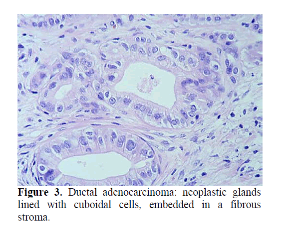 pancreas-ductal-adenocarcinoma