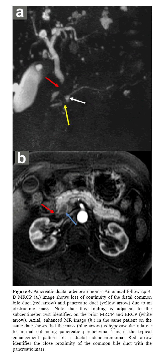 pancreas-ductal-adenocarcinoma