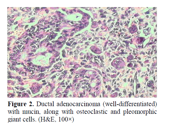 pancreas-ductal-adenocarcinoma