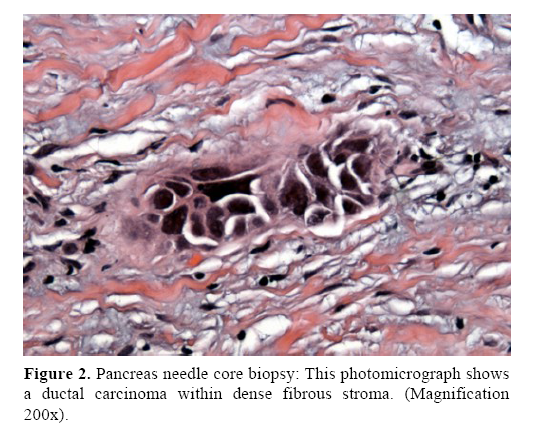 pancreas-ductal-carcinoma
