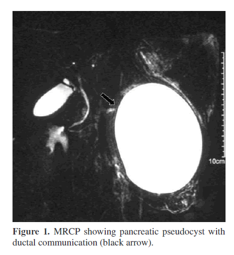 pancreas-ductal-communication