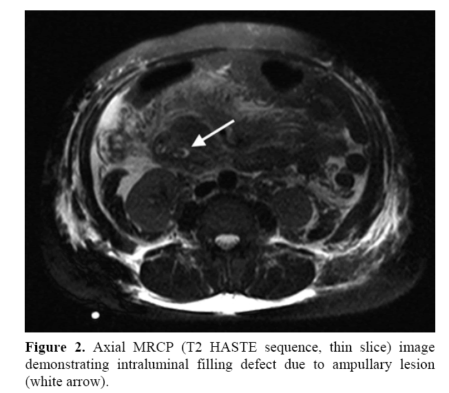 pancreas-due-ampullary-lesion