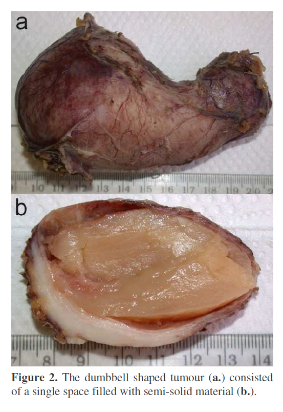 pancreas-dumbbell-shaped-tumour
