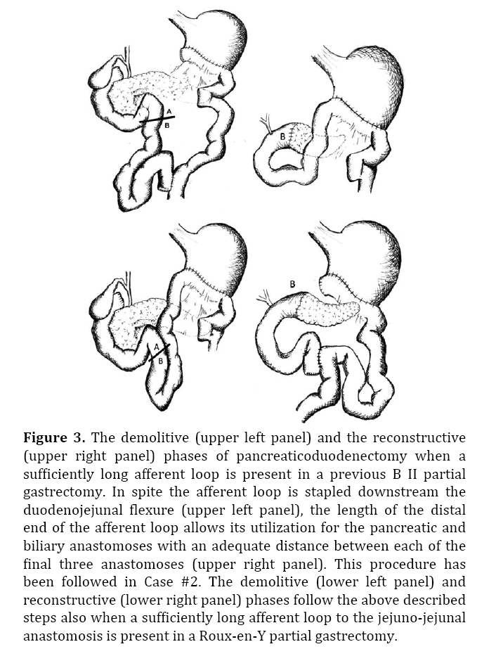 pancreas-duodenojejunal-flexure