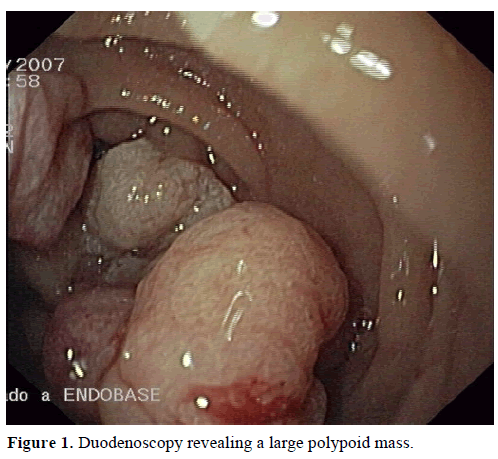 pancreas-duodenoscopy-large-polypoid