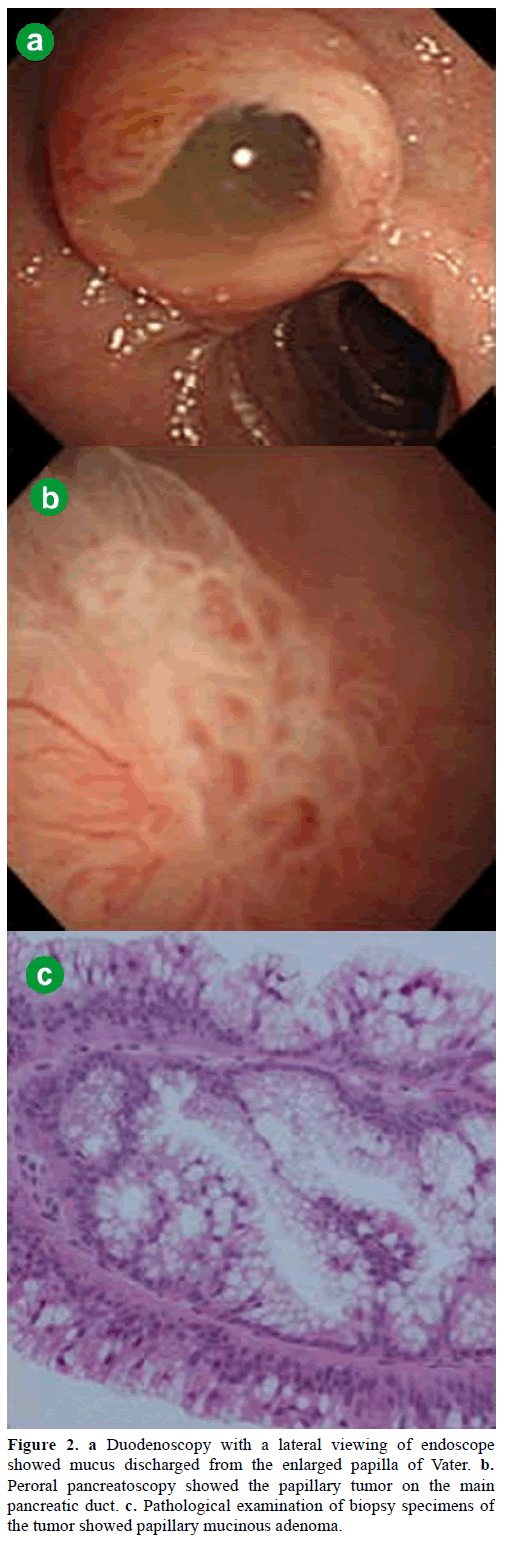 pancreas-duodenoscopy-lateral-viewing