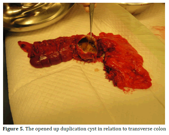 pancreas-duplication-cyst-transverse