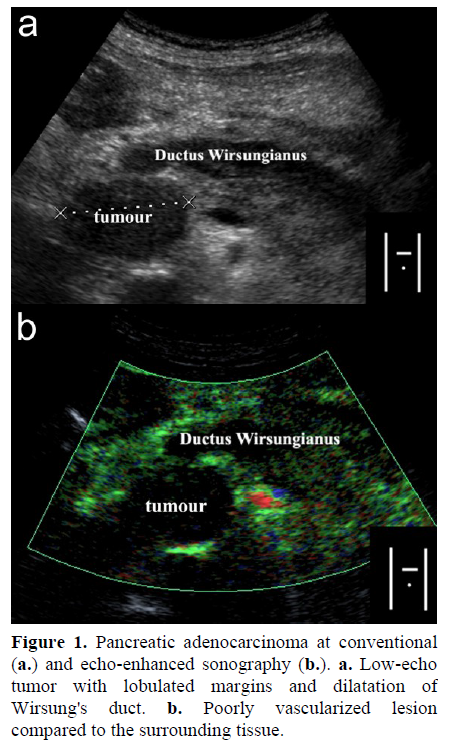 pancreas-echo-enhanced-sonography