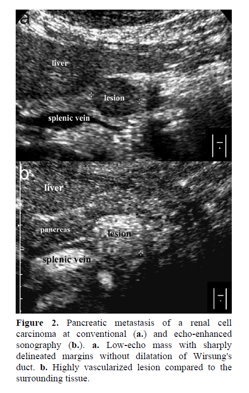 pancreas ultrasound