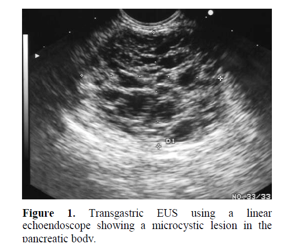 pancreas-echoendoscope-showing-microcystic