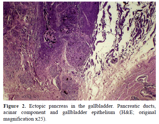pancreas-ectopic-pancreas-gallbladder