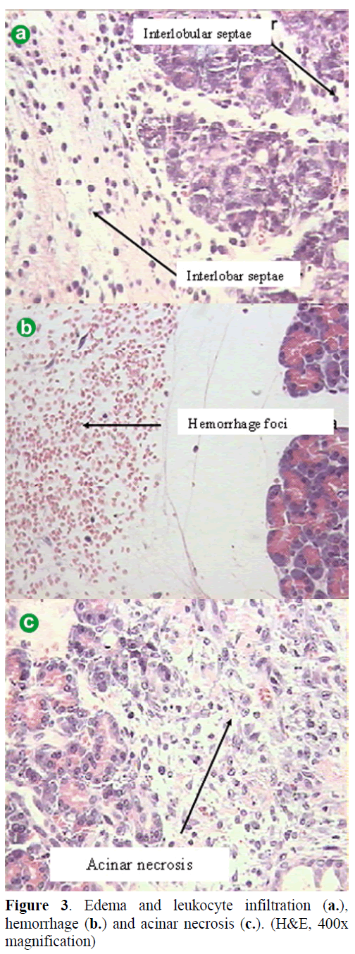 pancreas-edema-leukocyte-infiltration