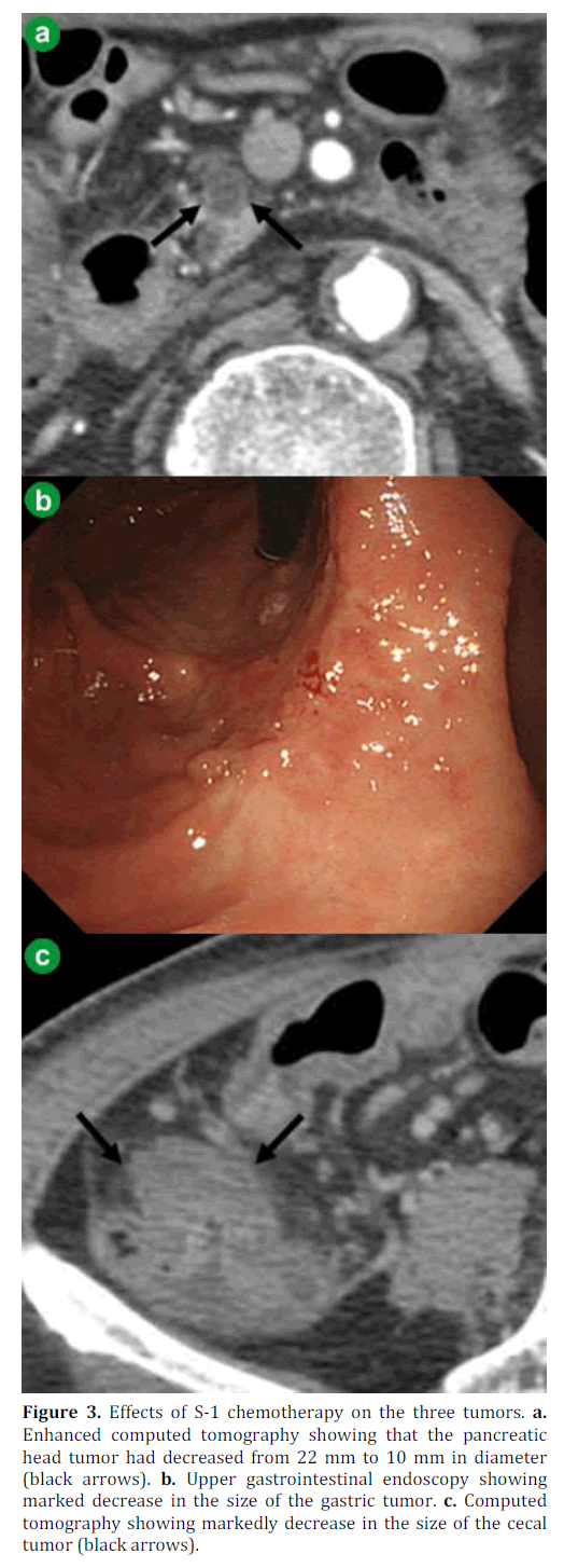 pancreas-effects-chemotherapy