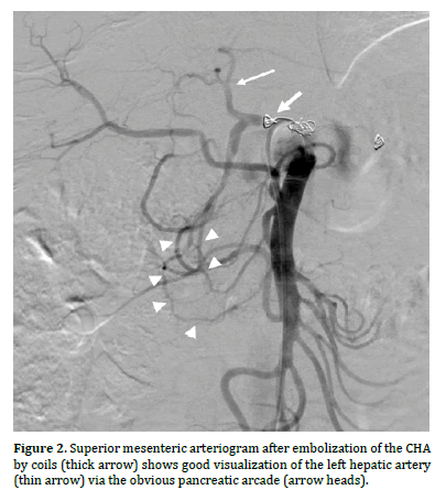 pancreas-embolization