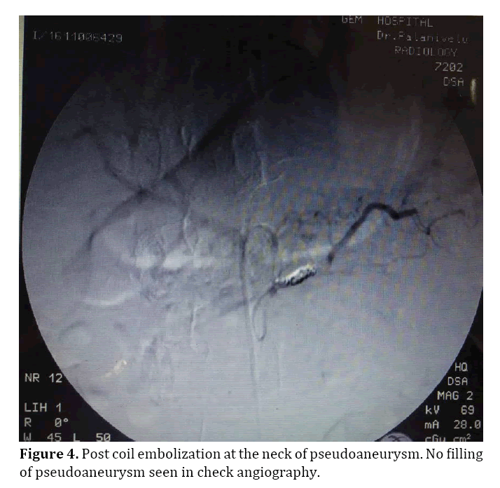 pancreas-embolization