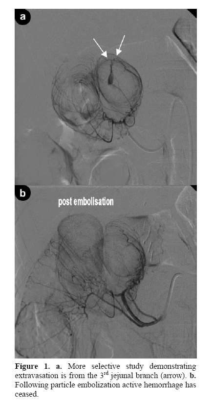 pancreas-embolization-active-hemorrhage