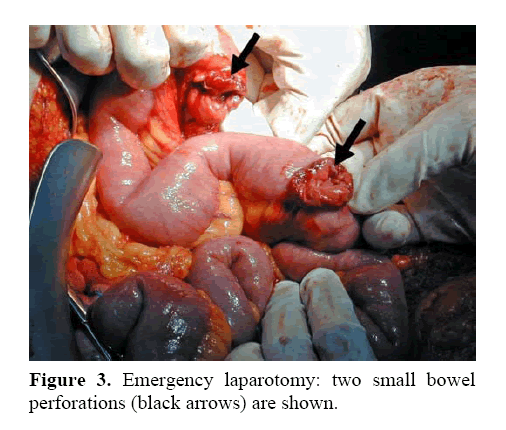 pancreas-emergency-laparotomy