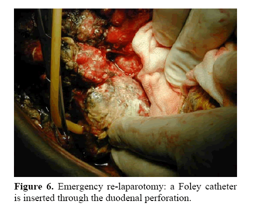 pancreas-emergency-re-laparotomy