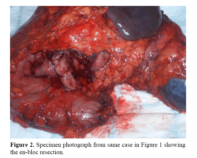 pancreas-en-bloc-resection