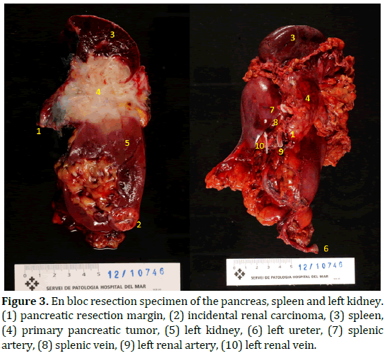pancreas-en-bloc-resection-specimen