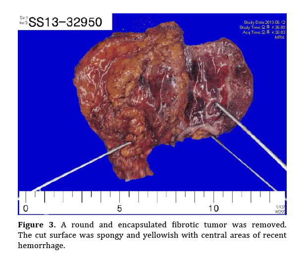 pancreas-encapsulated-fibrotic-tumor