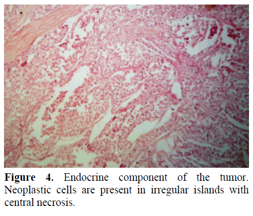 pancreas-endocrine-component-necrosis